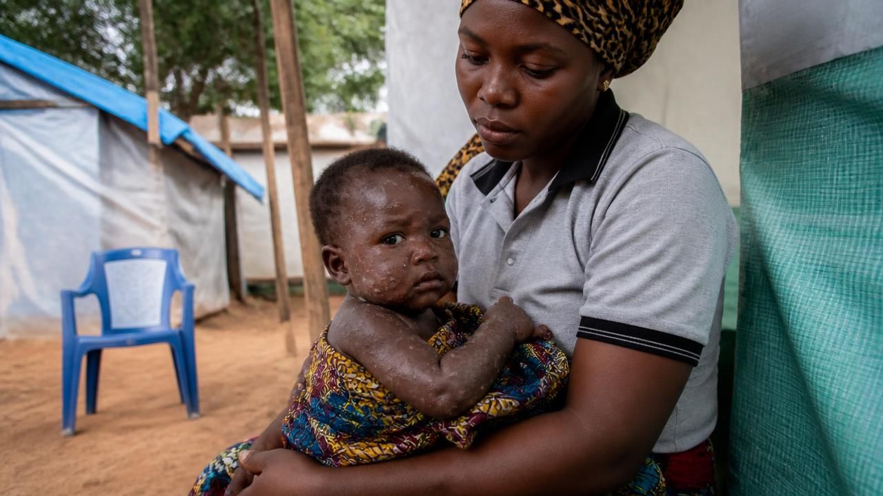 Children Make Up Half of Mpox Cases in Guinea-Bissau as First Outbreak Spreads